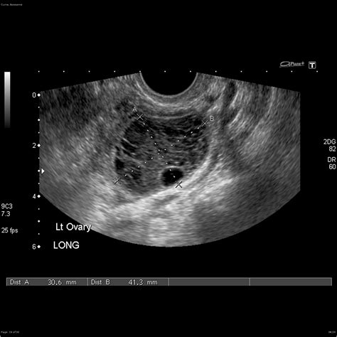Ovarian Dermoid Cyst Collection Of Ultrasound Images