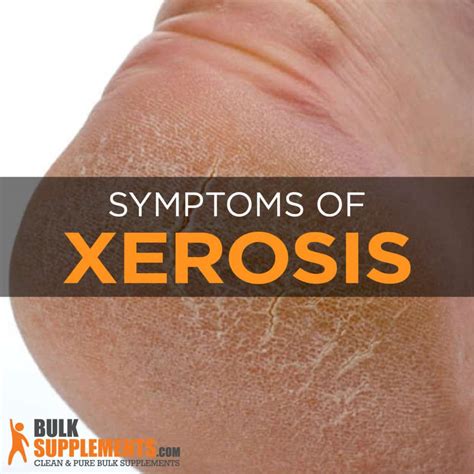 Xerosis (Dry Skin): Symptoms, Causes & Treatment