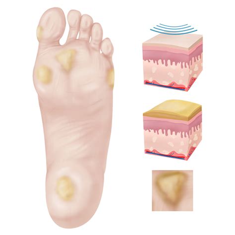 What Causes Calluses On The Bottom Of Your Foot Top Sellers ...