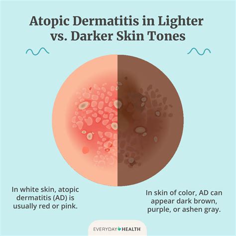 Atopic Dermatitis in Skin of Color: Symptoms, Causes, Diagnosis, and ...