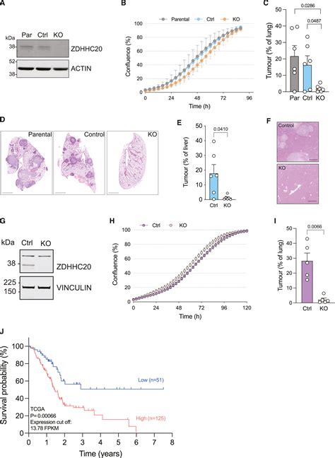 Palmitoyl transferase ZDHHC20 promotes pancreatic cancer metastasis: Cell Reports