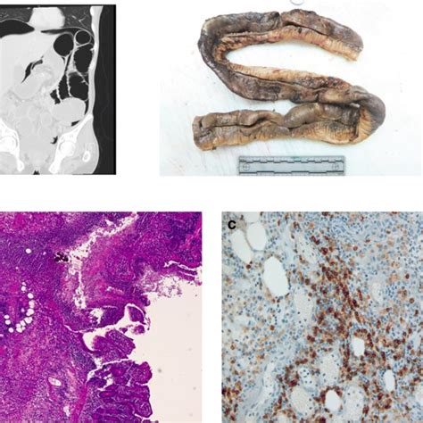 Image result for CT Scan Side Effects