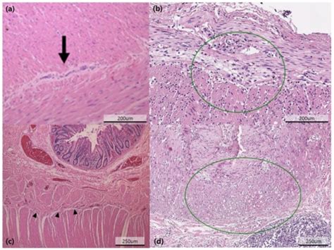 Clinical Outcomes of Pediatric Chronic Intestinal Pseudo-Obstruction