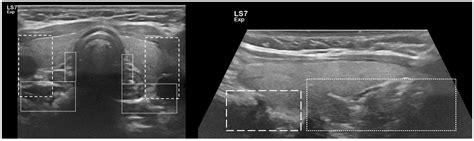 Parathyroid Gland Sonography