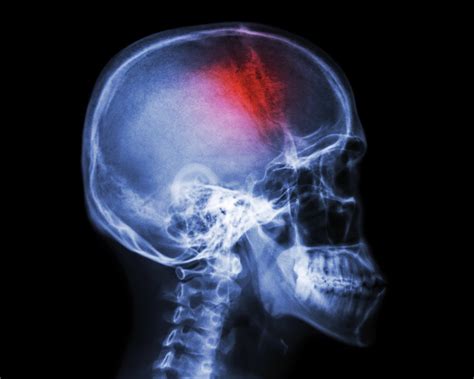 Cefaleas en Racimos – cefaleasenracimos.org