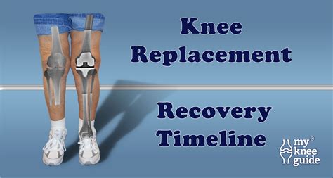 Knee Replacement Recovery 的图像结果