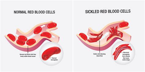 National Sickle Cell Anemia Elimination Mission | Manorama Yearbook