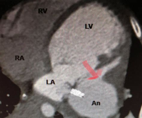 Submitral left ventricular aneurysm