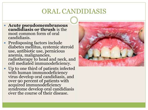 Candidiasis | PPTX