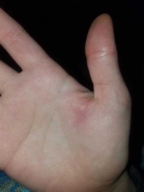 Hello medical people, I work as a dishwasher and got this painful ...