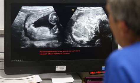 Nacen niños con daño cerebral a causa del zika - El Nuevo Día