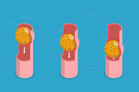 3D Isometric Flat Conceptual Illustration of Peristalsis, Swallow Eating Problem 67285308 Vector ...