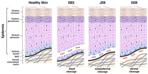 Emerging Gene Therapeutics for Epidermolysis Bullosa under Development