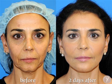 Face Lift Non Surgery