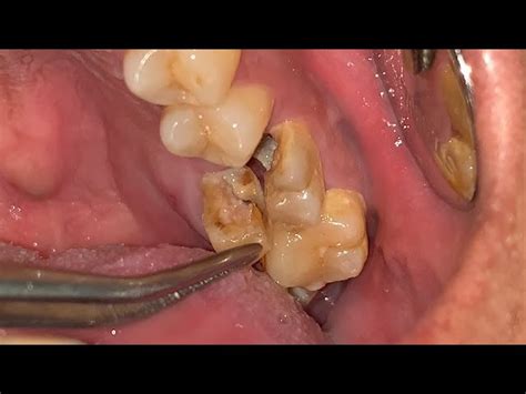 Image result for Abscess Explosion