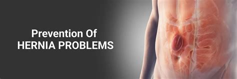 Prevention of Hernia Problems | Tips to Avoid Hernia Naturally