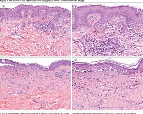 Compound Nevus With Mild Atypia