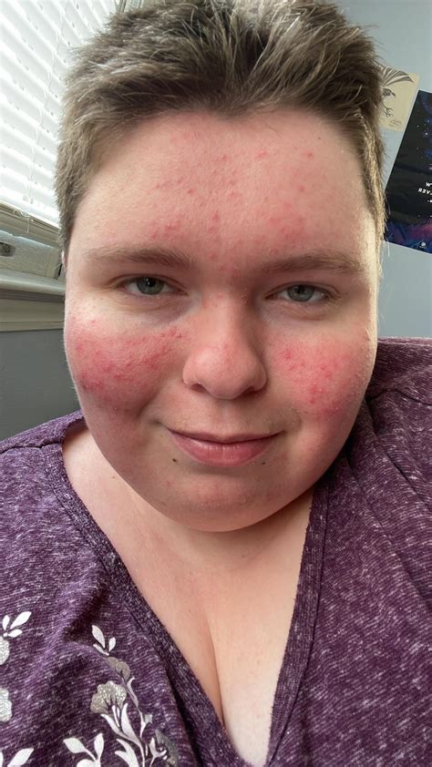 Rosacea or Undiagnosed Lupus/AutoImmune Condition? : r/skin