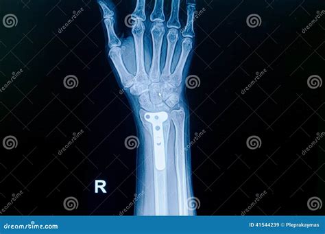 Film X-ray Wrist Fracture : Show Fracture Distal Radius Stock Photo ...