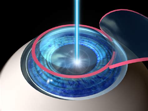 What is Laser Eye Surgery? - Lasik Eye Surgery Hawaii | Laser Eye Surgery Honolulu