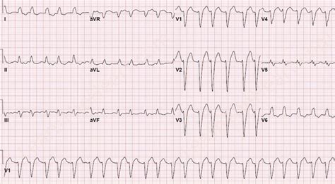 Image result for AFib Detection Algorithm