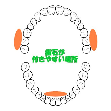 歯石　つきやすい　場所　イラスト に対する画像結果