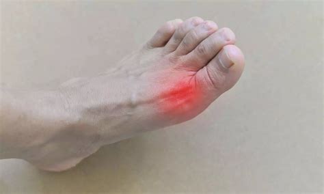 Is metabolic syndrome a modifiable risk factor for gout?