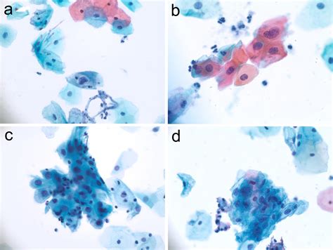 Atypical Squamous Cells Cervix