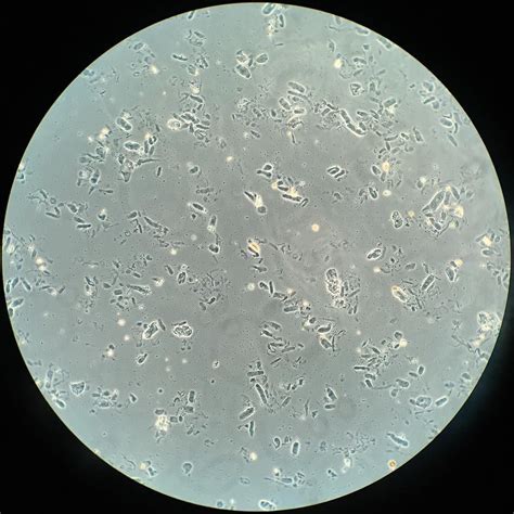 Abundant Hyaline Casts in a Volume Depleted Patient