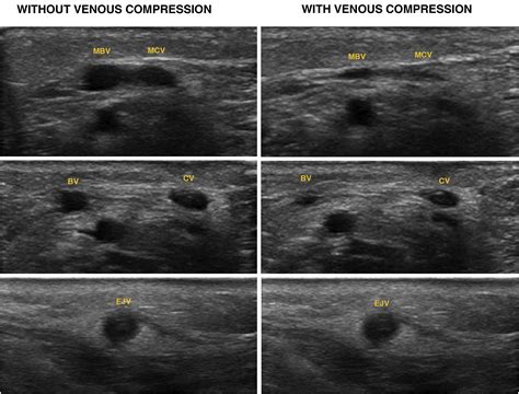 Catheter-related venous thrombosis: Simultaneous occlusion of cephalic and external jugular ...