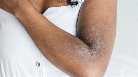 Image result for Exploding Elbow Pimple