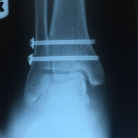 High Ankle Sprain X Ray