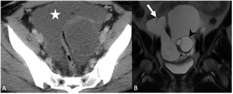 Mimics and Pitfalls of Primary Ovarian Malignancy Imaging
