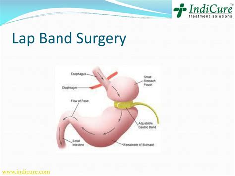 PPT - Laparoscopic Gastric Band Surgery In India - Cost PowerPoint Presentation - ID:1313245
