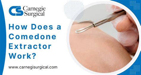 Image result for Solar Comedones Extraction