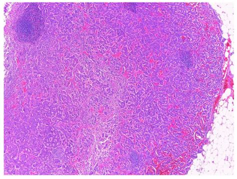 Duodenal Ampulla Neuroendocrine Tumor with GISTs of the Proximal ...