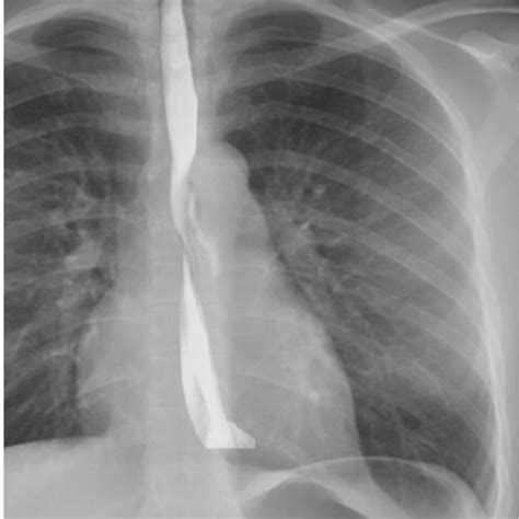 🚑 A 55-year-old man presents to the emergency department with severe retrosternal chest pain ...