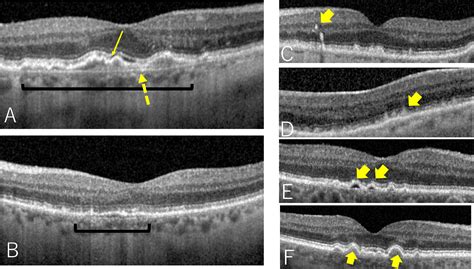 Optical Coherence Tomography Biomarkers for Conversion to Exudative Neovascular Age-related ...