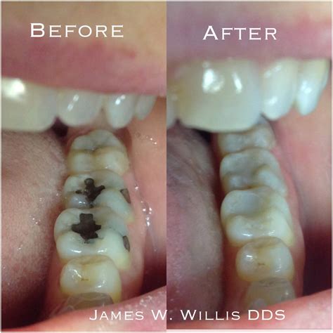 Smile Portfolio (Before & After) - Willis Family Dentistry