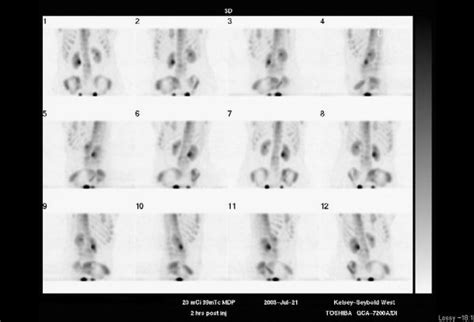 Image result for Radionuclide Scan