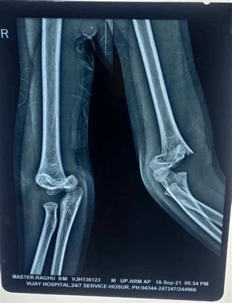 Nallampatti Broken Bone Best Treatement Centre - Medical - BEGAIPALLI ...