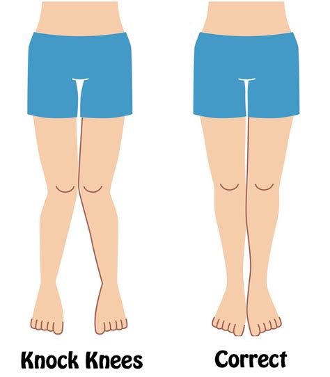 how to fix knock knees | Knock knees, Knee exercises, Knock knees exercises