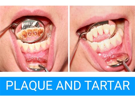Dental Plaque Removal