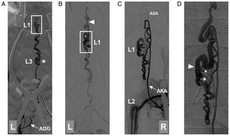 Artery Of Adamkiewicz Angiogram