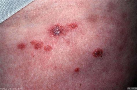 Pityriasis Lichenoides