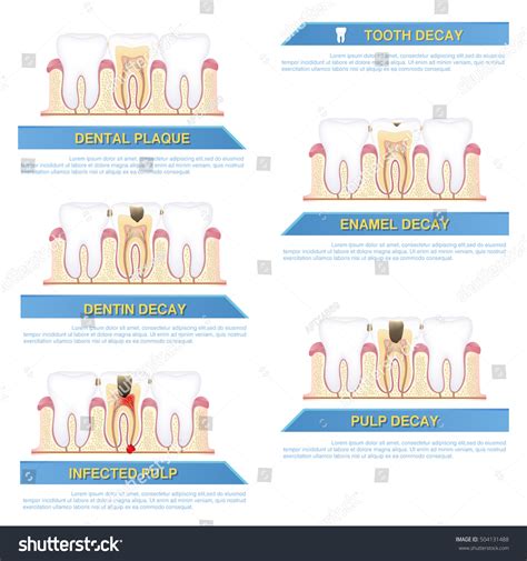 Infographic Dental Caries Stages Tooth Decay Stock Vector (Royalty Free) 504131488