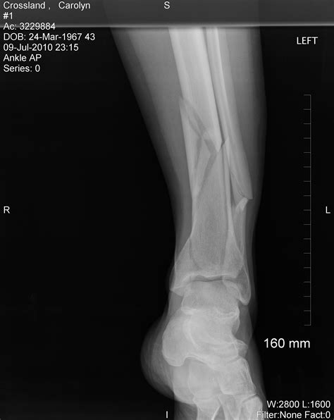 Spiral Fracture Of Fibula Healing Time