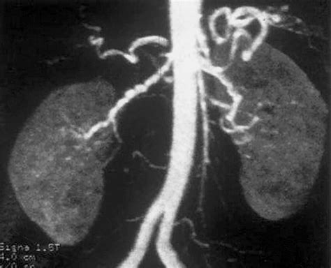 Classic Signs in Uroradiology | RadioGraphics