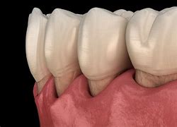 Image result for parodontitis
