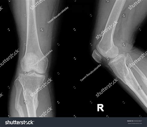 Collection Xray Normal Knee Stock Photo 500683867 | Shutterstock